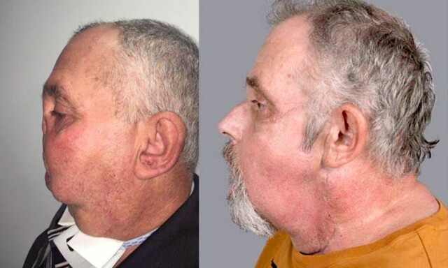 64-åringen ble verdens eldste til å få ansiktstransplantasjon